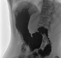 Gastroptosis as a Cause of Postprandial Abdominal Pain: A Case Report
