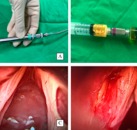 Intrauterine instillation of autologous platelet-rich plasma for boosting endometrial thickness and pregnancy result