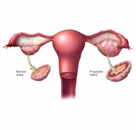 Inositol can effectively and safely manage polycystic ovary syndrome
