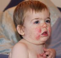 Herpes Zoster Ophthalmicus in Healthy 13-month Infant: An Unforeseen Scenario
