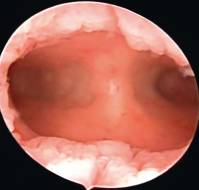 Hysteroscopic evaluation in patients with AUB and its correlation with histopathology