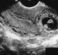 Interstitial Pregnancy: Case Report of Atypical Ectopic Pregnancy.