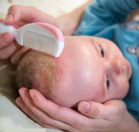 Interventions for infantile seborrheic dermatitis (including cradle cap)