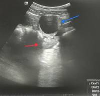 Isolated fallopian tube torsion in term pregnancy