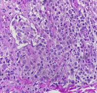 Langerhans Cell Histiocytosis Presented as Persistent Diaper Dermatitis