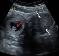 Laparoscopic Cerclage for Cervical Insufficiency in a Unicornuate Uterus with Previous Failed McDonald Cerclage: Successful Outcome