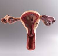 Long-Term Health Implications of Polycystic Ovarian Disease