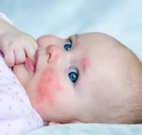 Lower Serum Interleukin-33 Levels in Infantile Atopic Dermatitis