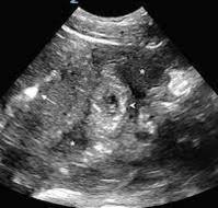 Management of Cervico-Isthmic Pregnancy with Fetal Death: A Case Report and Considerations for Fertility Preservation