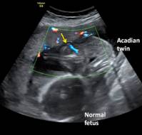 Management of a Delayed Diagnosed Acardiac Twin Pregnancy with TRAP Sequence