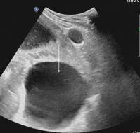 Management of breech presentation with a large pelvic hydatid cyst in late pregnancy