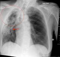 Management of pediatric pulmonary aspergillosis