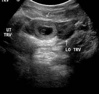 Monitoring ß-hCG levels can predict spontaneous resolution of an ectopic pregnancy