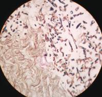 Mucormycosis of pouch of douglas in a diabetic lady: Report of a rare case