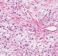 Myxoid ovaries resembling malignancy