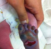 Neonatal Pain Response to Various Heel Prick Devices