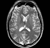 Neuroimaging Features in Eclamptic Encephalopathy