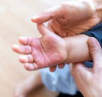 Non-pharmacological interventions lower the pain intensity of Children with Burns.