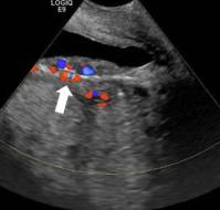 Obstetric and Maternal Outcomes after Before Uterine Artery Embolization