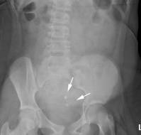 Ovarian Torsion in a Young Adolescent with Rokitansky Syndrome
