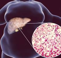 Pediatric Fatty Liver Disease
