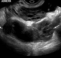 Pelvic inflammatory disease presenting 16 months after vaginal hysterectomy