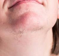 Pharmacotherapies for the treatment of hirsutism
