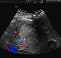 Placenta accreta in a mid-trimester post-abortal hemorrhage case