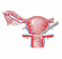 Placenta previa and uterine body accreta spectrum in pregnancy subsequent to uterine artery embolization