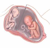 Pregnancy Outcomes of Previable and PROM following Laser Photocoagulation for Twin-Twin Transfusion Syndrome