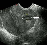 Pregnancy outcome after ultrasound-guided drainage and sclerosis of cystic adenomyoma