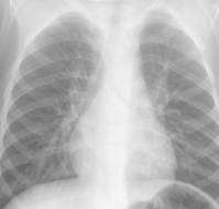 Procalcitonin as Point-of-Care Testing Modality for Diagnosing Pneumonia in Children With ILI