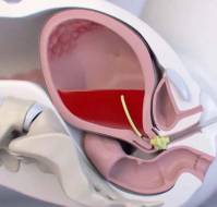 Real-World Utility of Intrauterine, Vacuum-Induced, Hemorrhage-Control Device