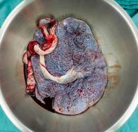 Retained Placenta and Postpartum Hemorrhage
