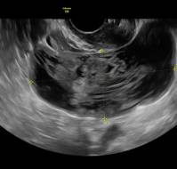 Retroperitoneal Hydropic Leiomyoma Mimicking an Ovarian Cyst
