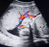 Second-trimester ultrasound, fetal biometrics and gestational diabetes