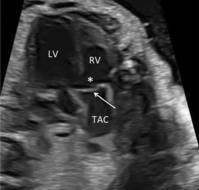 TAC: A Review of Prenatal Diagnosis, Associated Findings, and Postnatal Outcome of Fetuses
