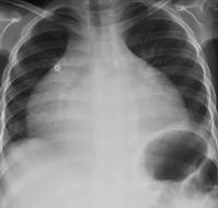 Tachycardia-Induced Cardiomyopathy in 5 years old