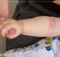 The use of Emollients in infancy prevents atopic dermatitis
