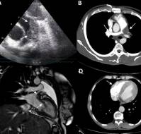 Treatment Response can aid in Determining the Cause of Unusual Recurrent Intracardiac Masses