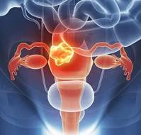 Treatment of endometriosis: a review with comparison of eight guidelines