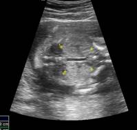 Ultrasound Identification of Morphological features in Trisomy 13 (Patau's Syndrome) Fetuses