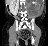 Urolithiasis with pyonephrosis in a child