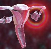 Use of Triglyceride and glucose index in women with polycystic ovary syndrome