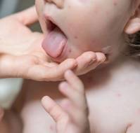 Varicella and Dengue Co-Infection in a Child
