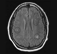 Vitamin B12 Deficiency Can Lead to Reversible Basal Ganglia Changes in Infants: A Case Study