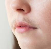 Which Hormone Should You Assess in Hirsutism: Testosterone or Dihydrotestosterone?