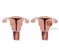 Medical vs. Surgical Approaches for the Conservative Management of Uterine Adenomyosis