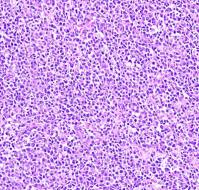 Non-Hodgkin's B-cell lymphoma of the ovary
