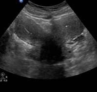 The Impact of Applying Autologous PRP within the Uterus on EMT and Pregnancy Outcomes